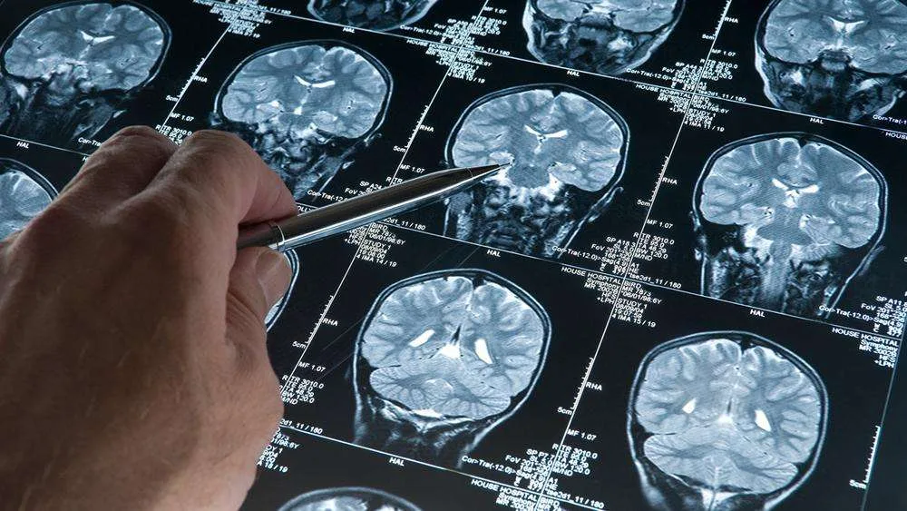 Alzheimer Belirtileri Daha Erken Başlayabilir