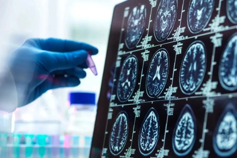Alzheimer Belirtileri Daha Erken Başlayabilir